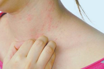 alergia en la piel