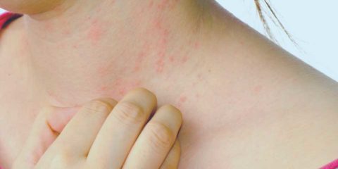alergia en la piel